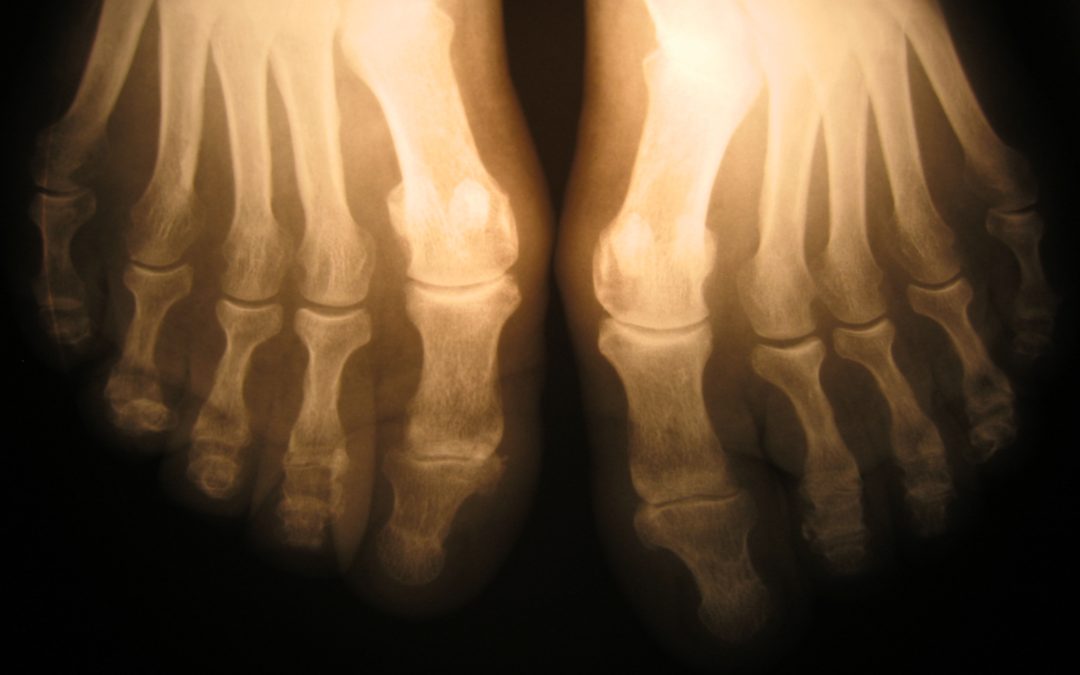X-Ray of Feet